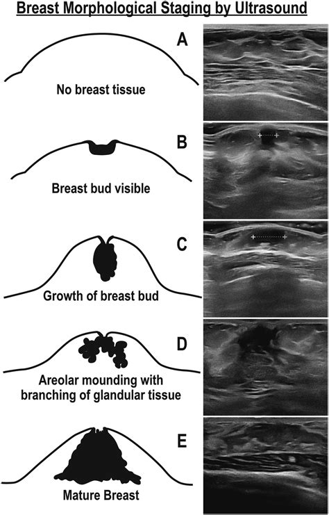 Breast Development During Puberty: Stages and Symptoms